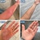 C+ Cream Eczema Psoriasis &amp; Dermatitis Relief, For Dry &amp; Itchy Skin, Clinically Tested Ingredients, Made For Sensitive Skin, 50 G