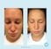 Glycolic Acid 30% Gel Peel - Enhanced With Retinol And Green Tea Extract (Professional Chemical Peel)