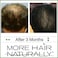 More Hair Naturally 9: Advanced Stem Cell Therapy For Thinning Hair. Helps Promote Healthier, Thicker And Stronger Hair Growth
