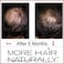 More Hair Naturally 9: Advanced Stem Cell Therapy For Thinning Hair. Helps Promote Healthier, Thicker And Stronger Hair Growth
