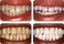 Ultra White 22% Teeth Whitening Gel Large 5 Tubes 3.8 ml of Gel