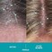 DS Laboratories Dandrene Dandruff Conditioner &ndash; Dry Scalp Treatment Conditioner, Seborrheic Dermatitis Conditioner, Conditioner for Itchy Scalp for Men and Women (205ml)