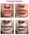 LifeCell Lip Plumping Treatment