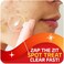 Asepxia Acne Treatment Cream,1 Oz
