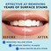 VENUS VISAGE Teeth Whitening Pen(2 Pens, 20Uses, EffectivePainless, No Sensitivity, Travel-Friendly, Easy to Use, Beautiful White Smile, Natural Mint Flavour.