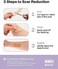 AWD Medical 100% Soft Silicone Gel Tape (1.6" x 60"Highly Comfortable Painless 6-8 Month Supply Acne Scar Treatment C Section Keloid Surgery Premium Hospital Medical Grade (4.1cm x 150cm