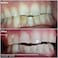 Crystal Clear Teeth Whitening Kit, USA Dentists Approved, Teeth Whitening Gel with LED Light, 30ml Gel and Tray
