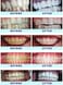 Crystal Clear Teeth Whitening Kit, USA Dentists Approved, Teeth Whitening Gel with LED Light, 30ml Gel and Tray