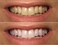 ProDental Teeth Whitening Gel Syringe Refill 10 Pack35% Carbamide Peroxide - 60 TreatmentsFaster Results Than Tooth Whitening Strips - Pen - Powders and ToothpasteSafe for Sensitive Teeth