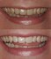 ProDental Teeth Whitening Gel Syringe Refill 10 Pack35% Carbamide Peroxide - 60 TreatmentsFaster Results Than Tooth Whitening Strips - Pen - Powders and ToothpasteSafe for Sensitive Teeth