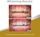 Opalescence Quick RF 45% Teeth Whitening Gel Mint Flavor