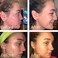 Dr Song Benzoyl Peroxide Wash 10 percent Acne Treatment: Acne Face WashBody Wash