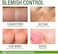 GRAMRIGHT Acne Treatment Face Cream - Acne Spot Treatment for FaceAcne Dots - Tea Tree Oil for Acne - Natural Cystic Acne Treatment -Made in USA- For All Skin Types - Acne Scar CreamPimple Remover 4 f
