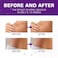 Kelinul Silicone Scar Sheets(1.6'' x 60''Roll-1.5M- Soft Silicone Gel Scar Tape Painless Silicone Tape Roll - Reusable, Medical Grade Silicone Scar Removal Strips for C-SectionKeloid Surgery, Burn, Ac