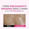 ISOI Blemish Care Up Serum 35ml (1.18 fl.ozVegan Serum for BlemishDark Spot Removal with Arbutin, Bulgarian Rose OilKorean Skin Care