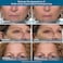 Plexaderm Rapid Reduction Eye Serum  Advanced Formula Anti Aging Visibly Reduces UnderEye Bags Wrinkles Dark Circles Fine Lines  Crows Feet Instantly Instant Wrinkle Remover for Face