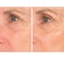 SiO Beauty Eye and Smile SuperLift  Eye  Lip AntiWrinkle Silicone Patches  Reduce Smile and Under Eye Wrinkles Overnight