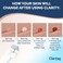 Advanced Skin Tag Remover  FDACleared Device  Only for Skin Tag Removal  Works in 714 Days  Up to 10 Treatment Cycles  Cryogenic FreezeOff Kit