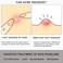 Pointed Blackhead Removal 2in1 Acne Extractor Tool  Stainless Steel Whitehead Remover for FaceNose