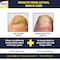 NONYX Fungal Nail Clarifying Gel  Rids Nails of Fungus by Removing Keratin Debris Where Nail Fungus Grows  90 of Toenails Improved Using this Toenail Fungus Treatment  4 oz
