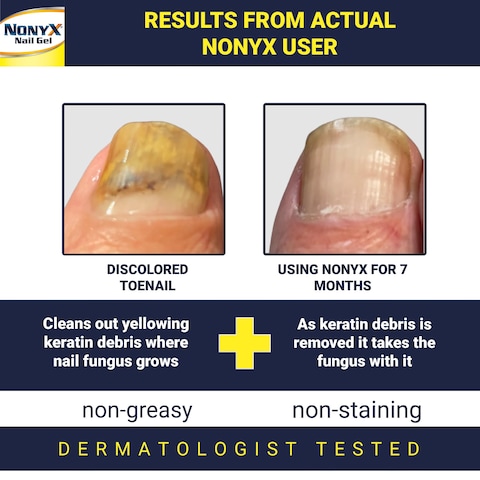 NONYX Fungal Nail Clarifying Gel  Rids Nails of Fungus by Removing Keratin Debris Where Nail Fungus Grows  90 of Toenails Improved Using this Toenail Fungus Treatment  4 oz