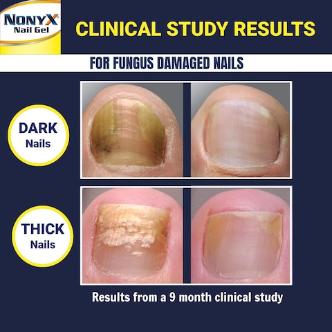 NONYX Fungal Nail Clarifying Gel  Rids Nails of Fungus by Removing Keratin Debris Where Nail Fungus Grows  90 of Toenails Improved Using this Toenail Fungus Treatment  4 oz