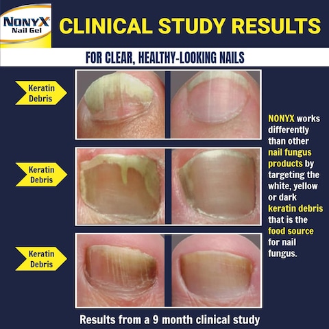 NONYX Fungal Nail Clarifying Gel  Rids Nails of Fungus by Removing Keratin Debris Where Nail Fungus Grows  90 of Toenails Improved Using this Toenail Fungus Treatment  4 oz