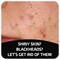 Asepxia with Activated Charcoal Purifying Effect Acne Treatment Bar Soap with Salicylic Acid 4 Ounce