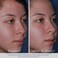 ObagiCLENZIderm MD Therapeutic System  3 Step Acne Treatment System Includes 2 Salicylic Acid BHA Cleanser 2 Salicylic Acid BHA Exfoliating Toner 5 Benzoyl Peroxide BPO Acne Treatment