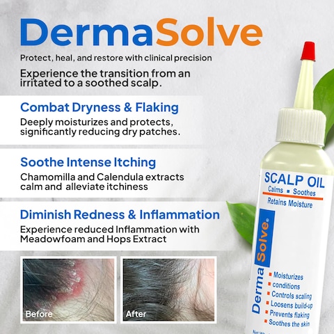 Dermasolve4 oz Psoriasis Seborrheic Dermatitis  Dandruff Scalp Oil  Dermatologist Approved  Itchy Flaky Scalp Relief  Clinically Tested LongLasting ItchFree HighPerformance Formula