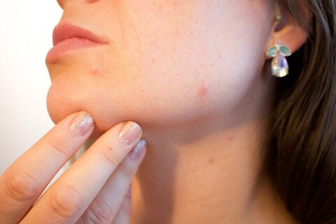 Quick Clear Blemish Control Acne Spot Treatment Drying Lotion Face Back Chest Zit Pimple Treatment Cold Sore Remedy Men Women Teens