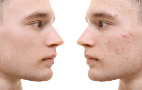 Quick Clear Blemish Control Acne Spot Treatment Drying Lotion Face Back Chest Zit Pimple Treatment Cold Sore Remedy Men Women Teens