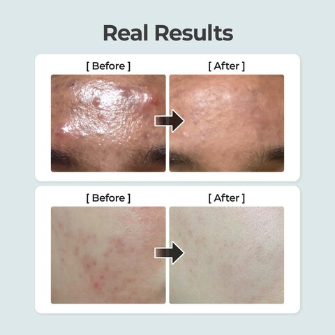 numbuzin No1 PureFull Calming Herb Toner  Breakouts Redness Excess Oil Control Blackhead Removal  Centella Asiatica Heartleaf Licorice Root  AcneProne Sensitive Skin  1014 fl oz
