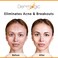 Acne Treatment Pads-Contains Glycolic, Lactic, Salicylic Acid. Eliminates Oily Skin, Clogged Pores &amp; Cystic Breakouts. Removes Dark Spots, Whitehead &amp; Blackhead Pimples for Face &amp; Body.