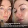 Shira Solar Energy Drying Lotion Acne &amp; Oily Skin, Effective Acne Spot Treatment for All Skin Types,Safe Lotion for Pimple Spot Treatment(15ml)