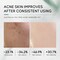 Skin Care Set,Acne Treatment for Face Skin Care Sets &amp; Kits,Tea Tree Essential Oil Facial Skincare Gift Set with Cleanser,Toner,Serum,Gel, Acne Treatment Kit Cream Skin Care for Teens 10-12 Girls Boys