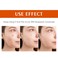 Acne Treatment Cream for Face &amp; Body - Anti-acne Moisturizer for Teens &amp; Adults - Spot Treatment for Breakouts &amp; Blemishes - 30g
