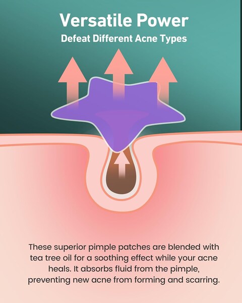 Star Acne Pimple Patch 140 Counts, Hydrocolloid Acne Patches for Face, Purple, Blue, Green, Pink and Yellow