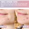 Pimple Patches Hydrocolloid Heart Shaped,5 Packs 108 Dots Waterproof Facial Pimple Stickers Blemish Cover Acne Stickers Zit Patchs Makeup Supplies