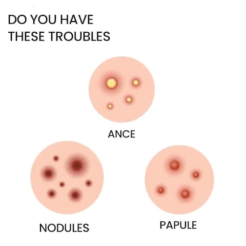 Star-Shaped Acne Patches for Face - Cute Pimple Patches with Hydrocolloid, Tea Tree Oil &amp; Hyaluronic Acid   Gentle Overnight Spot Treatment for Skin Repair