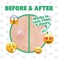 Pimple Buster Pimple Patches for Face Tea Tree- Hydrocolloid Acne Patches for Blemishes &amp; Breakouts and Absorbing Zits, Recover the Spot Quickly, Cover Spot from Dirt, Invisible Finished