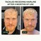 Bio-Pilixin Activation Serum 100ml with Clinically Tested Results in 150 days - Scandinavian Biolabs Hair Loss Serum for Men Sulphate Free - No Silicones No Parabens