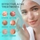 Acne Treatment Cream for Face, Back, Butt, Body - Spot Treatment for Pimples, Blemishes, Blackheads, Oil Control - Natural Ingredients - for Teens, Women, and Men