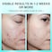 Acne Treatment Cream for Face, Back, Butt, Body - Spot Treatment for Pimples, Blemishes, Blackheads, Oil Control - Natural Ingredients - for Teens, Women, and Men