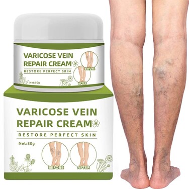 Spider Veins Repair Cream for Legs - Varicose &amp; Spider Veins Leg Treatment (50g)