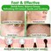 Acne Spray/Treatment, Body/Back/Face/Chest Clear Acne Spray, Skin Care, Contain Natural Organic Tea Tree Oil For Skin To Peace Out Acne Healing Dots, Balance And Moisturizing - 4.3 OZ