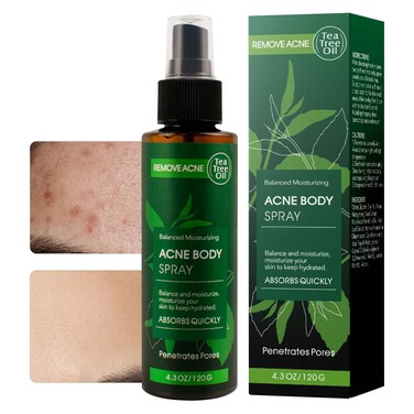 Acne Spray/Treatment, Body/Back/Face/Chest Clear Acne Spray, Skin Care, Contain Natural Organic Tea Tree Oil For Skin To Peace Out Acne Healing Dots, Balance And Moisturizing - 4.3 OZ