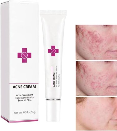 Acne Cream Pimple Cream for Face, Oil Control Pimple Remover Cream Get Rid of Pimples Fast,for Oily and Acne Prone Skin, Cruelty Free, Crema para espinillas en la cara