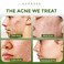 Exposed Skin Care Acne Treatment Kit - Includes Facial Cleanser, Clearing Tonic, Acne Treatment Serum, Clear Pore Serum, Clarifying Mask, Cloth - Natural Acne Solution for Face, All Ages &amp; Skin Types