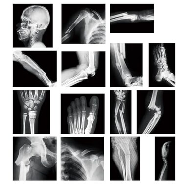 Sayglossy 15 Pcs Broken Bones x Ray Set Human x Rays Black and White Skeleton Pretend Xrays for Kids